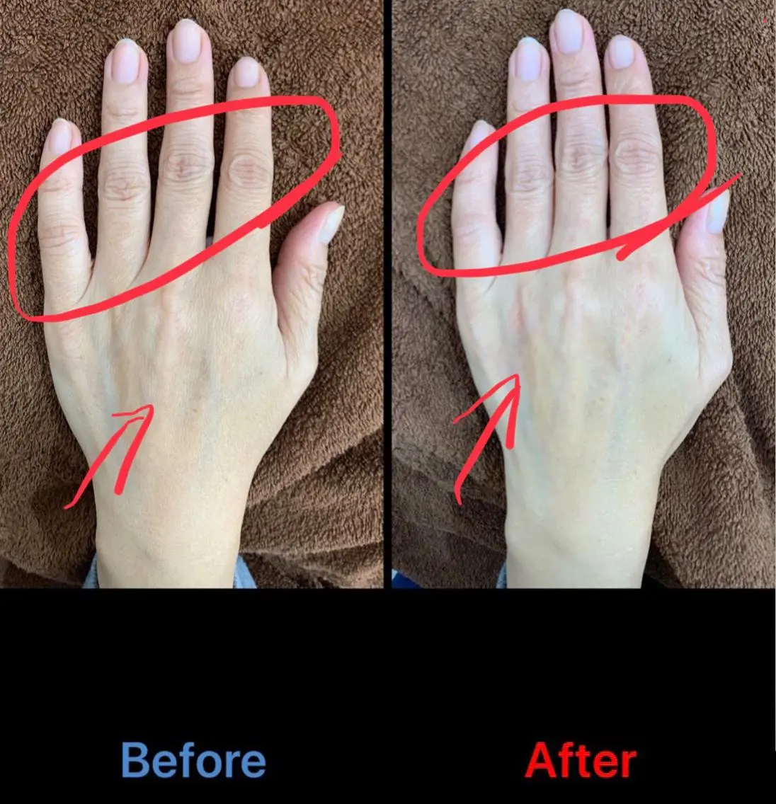 【🤚年齢が出やすい手✋】シワやたるみ気になっていませんか？？指脱毛＋ハンドエステで若々しい手に✨　　ハンドパック付きの写真