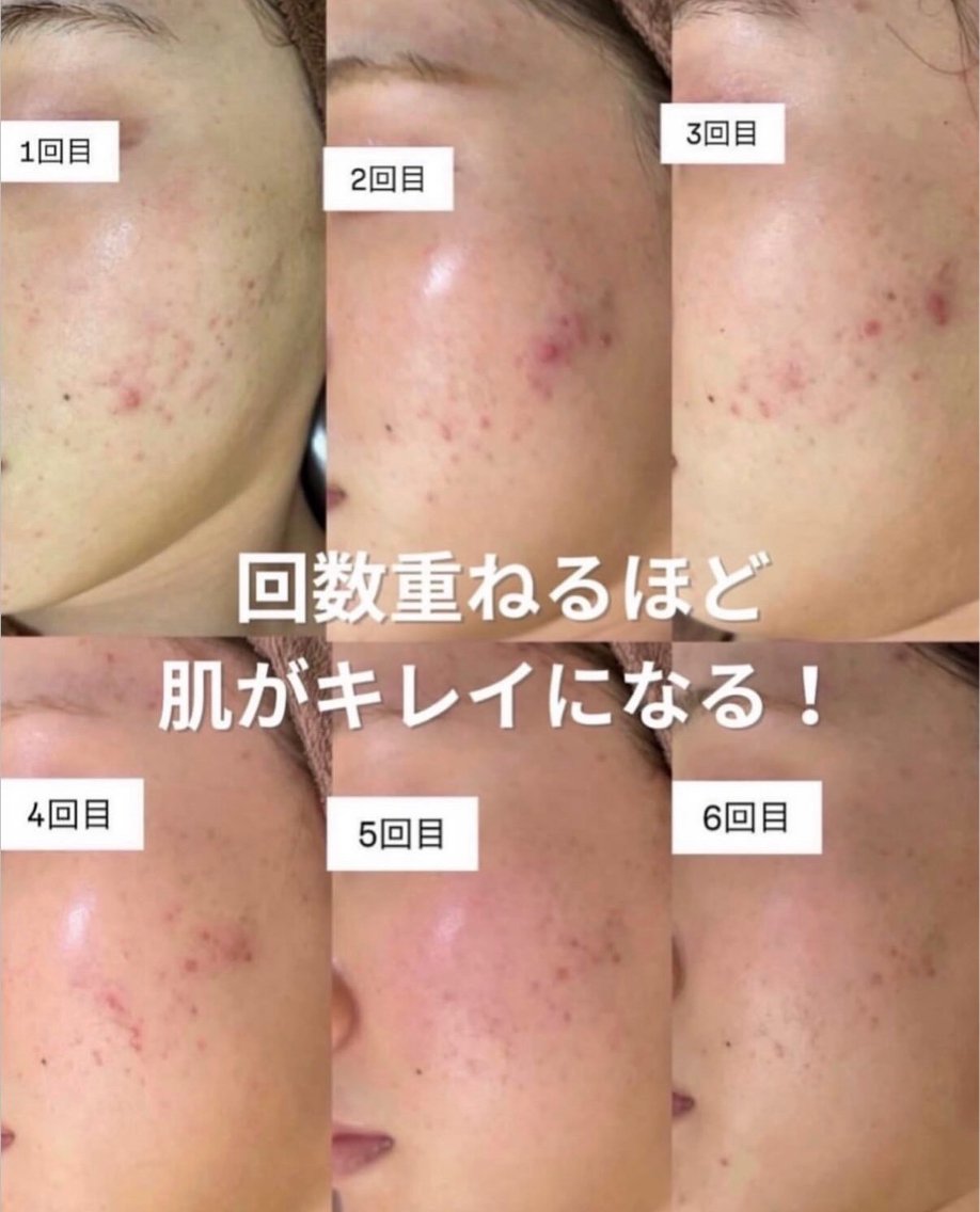 エステ 柏/肌管理専門店/ ⭐️サトウレノン🌟のエステ・リラクイメージ