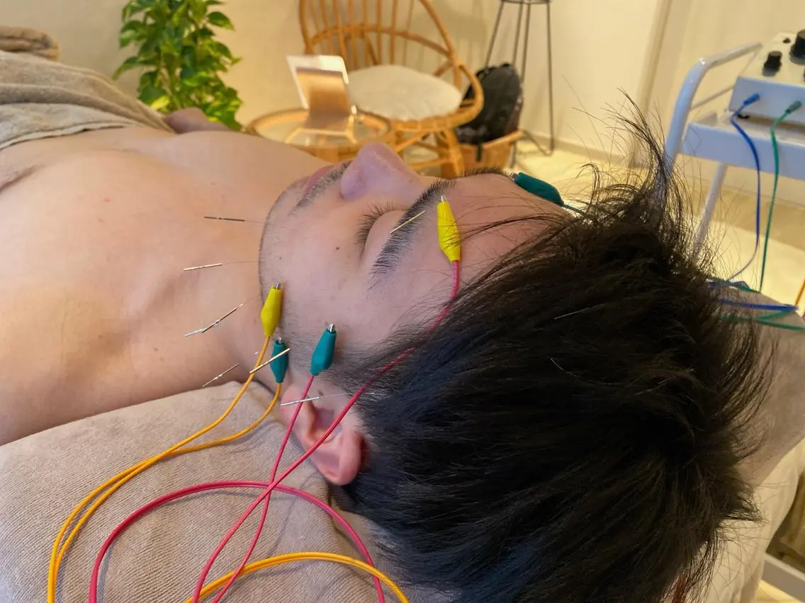男を上げるメンズ美容鍼の写真
