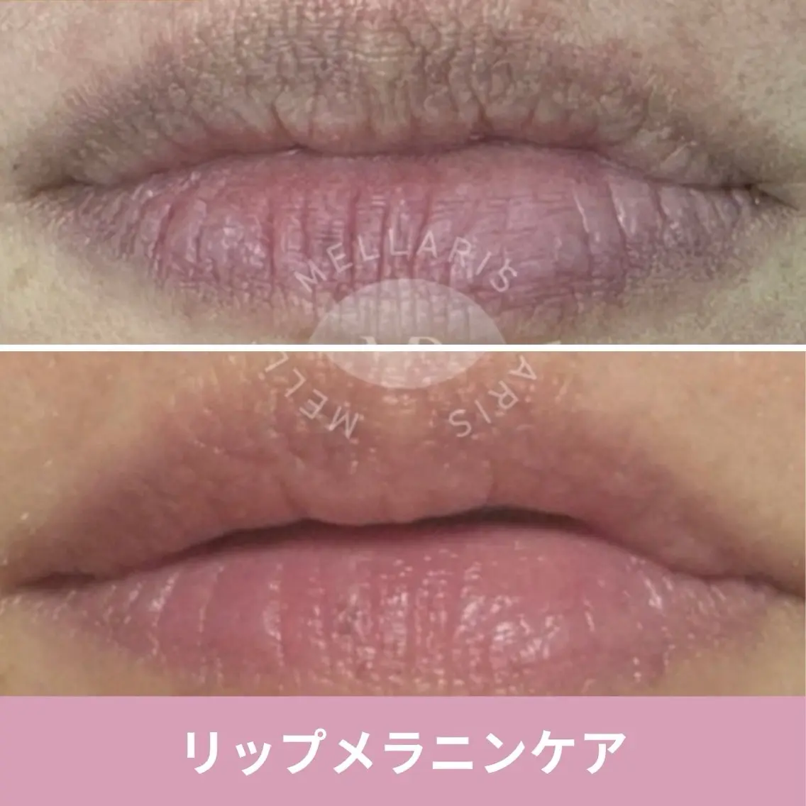 リップ黒ずみ除去💋アフターケアクリーム付！国産メラニンケア✨唇をピンクに！ルメラ・ローマピンクの次世代版の写真