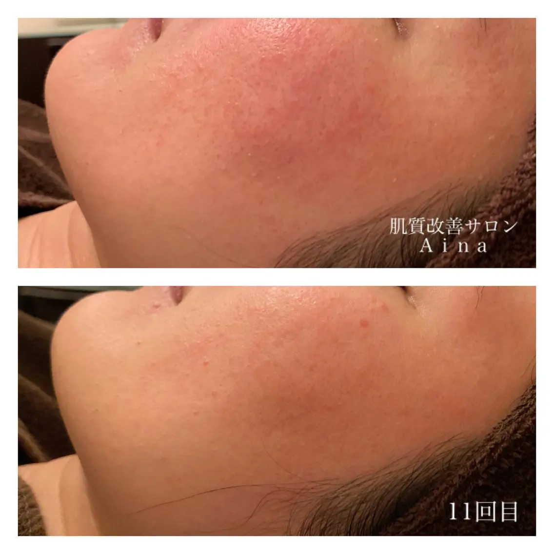 ロング カラー パーマ ヘアアレンジ メンズ キッズ ネイル マツエク・マツパ 赤色 エステ リラク ニキビ跡専門サロン Ainaのエステ・リラクイメージ