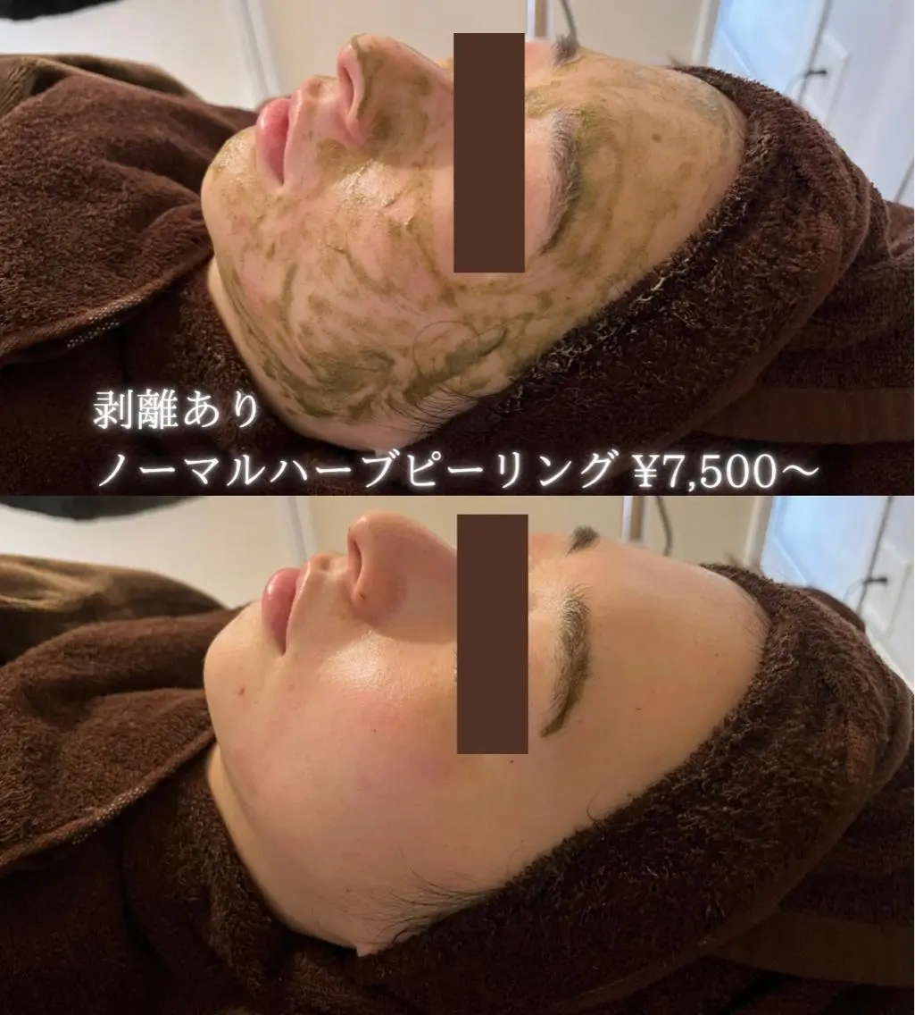 【キャンペーン】剥離ありノーマル・ハーブピーリング 🌿薄皮程度の皮剥けありダウンタイム3〜5日間あり✨の写真