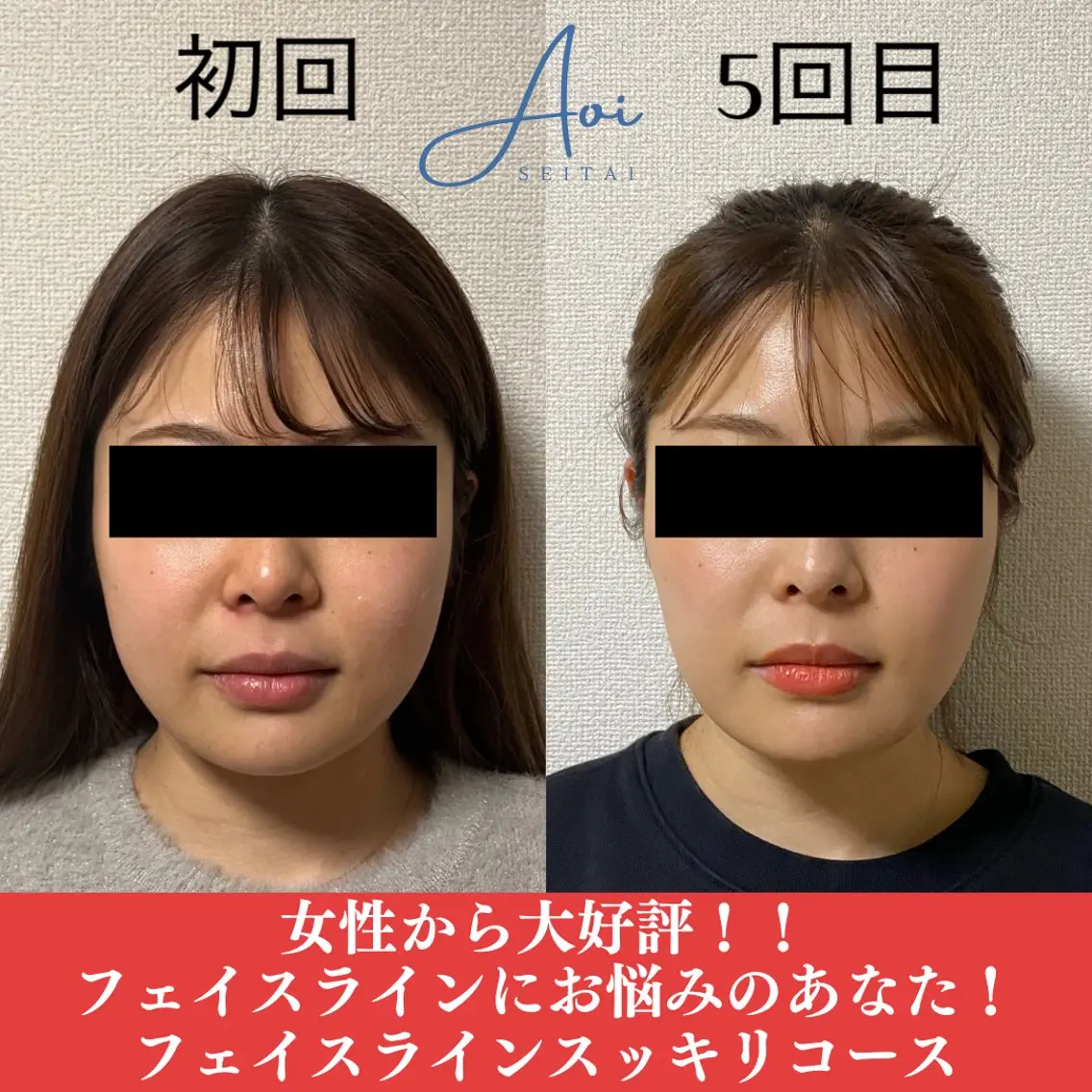 【美容鍼60本】フェイスライン・リフトアップケア60分 ¥8000→¥4000の写真