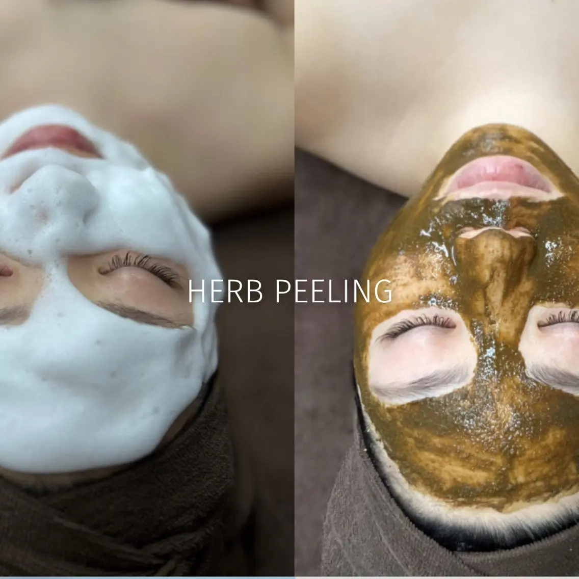 人気No.1👑《ニキビ/シミケア》メディカルハーブピーリング🌿剥離なしで陶器肌✨の写真