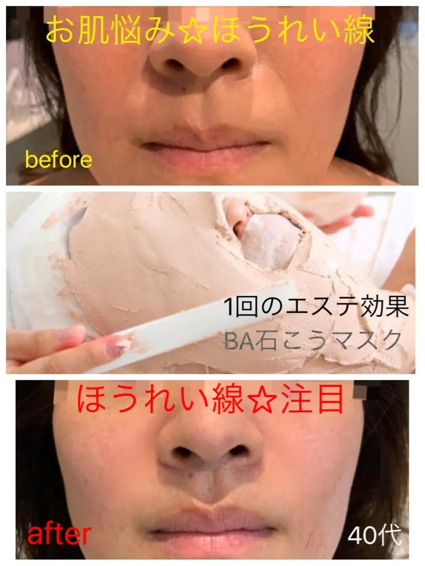 ハリたるみ、ほうれい線、小ジワ、シワが気になる方は石こうマスクでしっかり引き上げ！一回の効果実感で頬の高さが変わります！の写真
