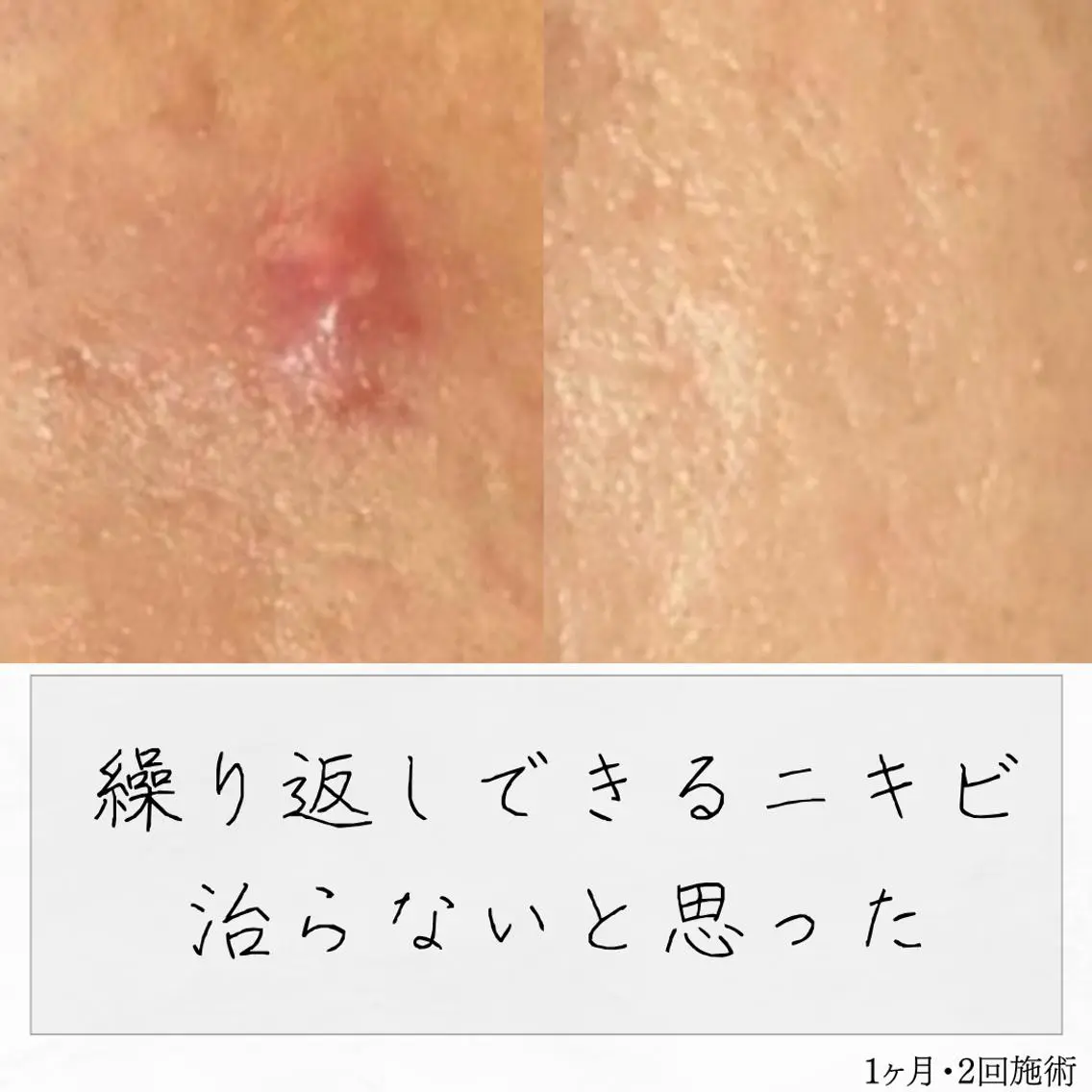 ニキビ経験者が施術 する専門サロン🌻のエステ・リラクイメージ
