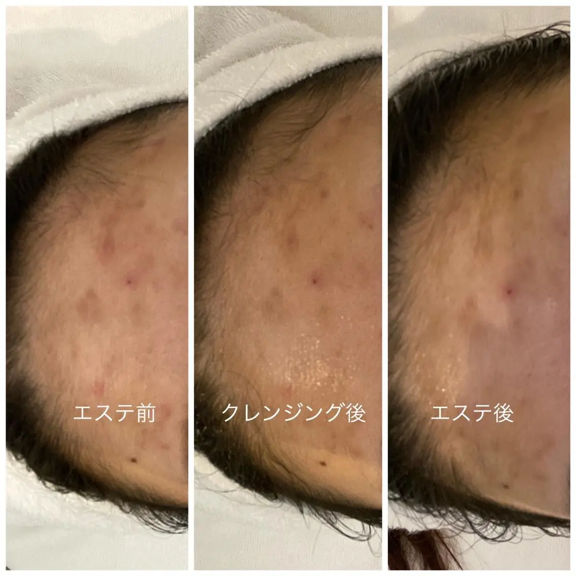 【20代〜30代メンズ限定👱♂️】フェイシャルエステ+毛穴吸引(ニキビ、毛穴、皮脂)の写真