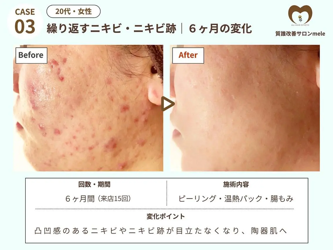 エステ リラク ニキビケア・毛穴専門 mele|もりぞののエステ・リラクイメージ