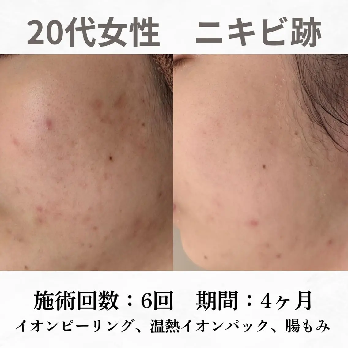 重度ニキビ専門🌷 ダウンタイムなしのエステ・リラクイメージ