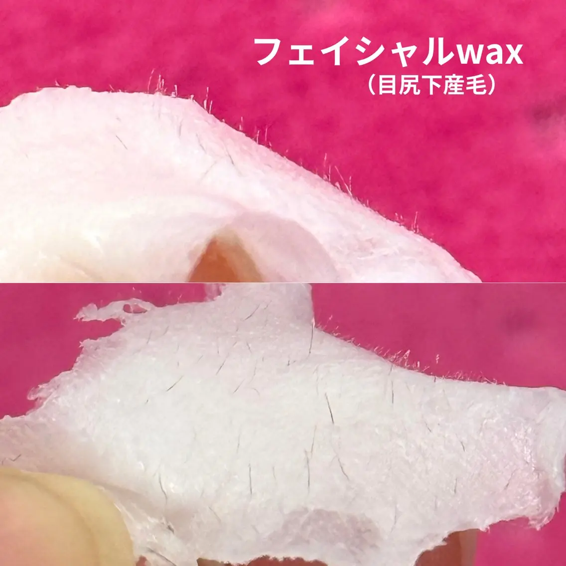 フェイシャルwax脱毛の写真