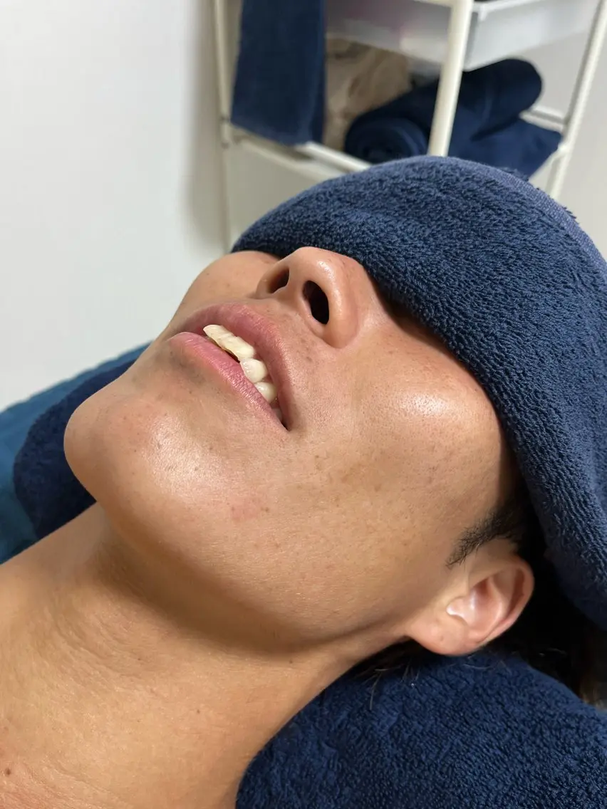 【初回限定】ヒゲ脱毛🥸の写真