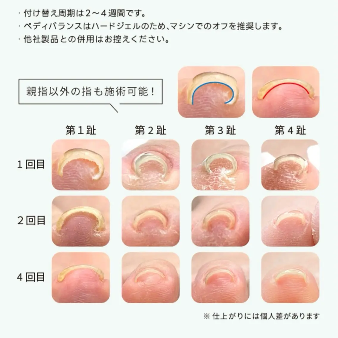 痛くない巻き爪改善ネイル👣 (オフ+¥500)の写真