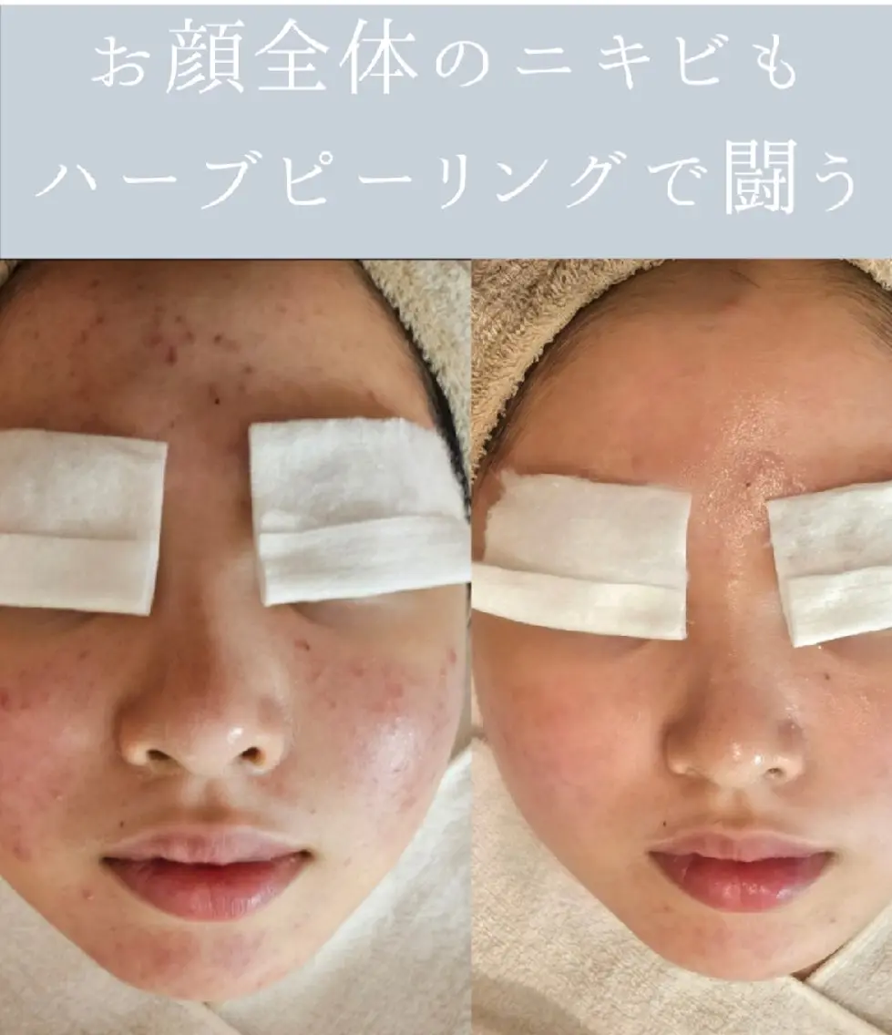 【微剥離】ハーブピーリングの写真