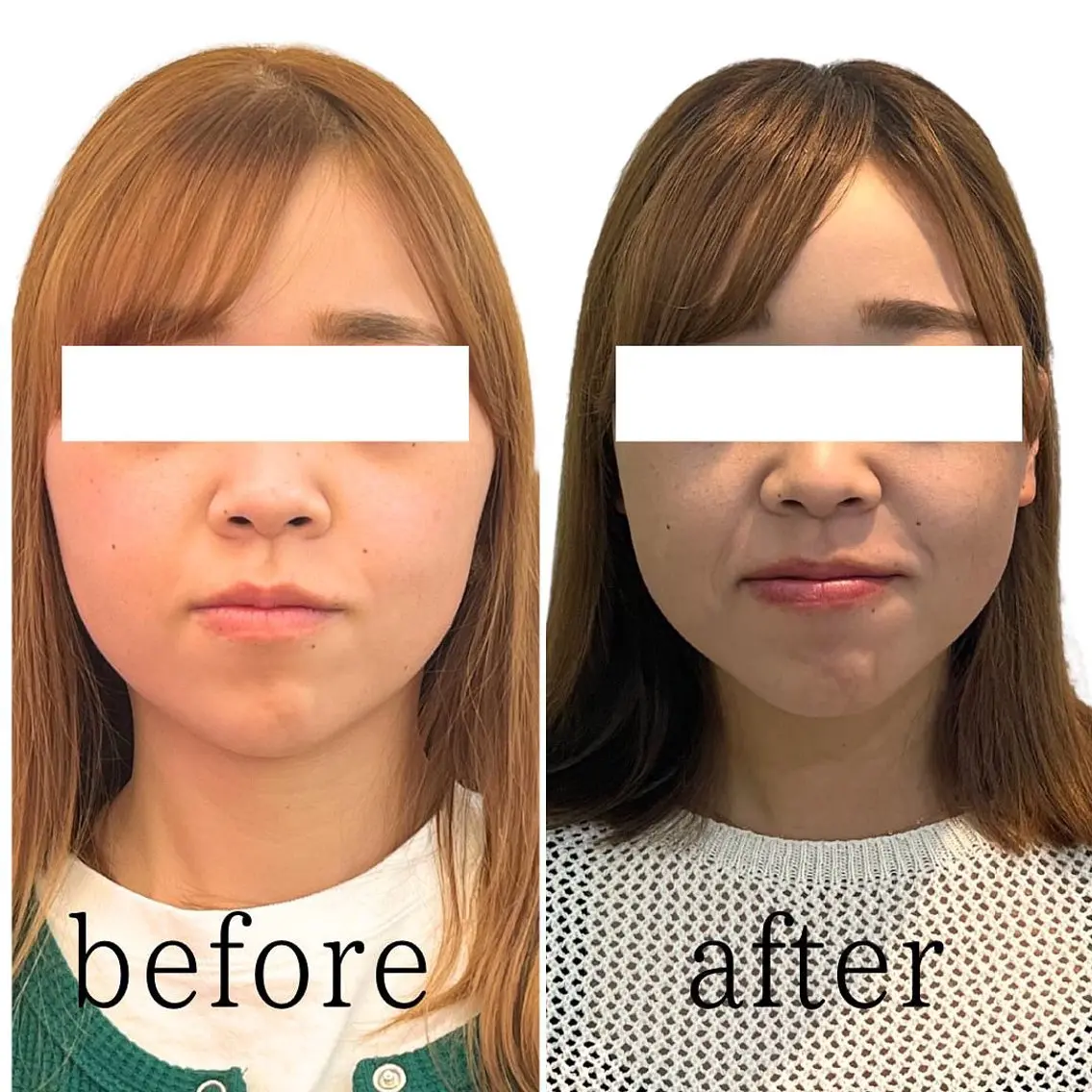 【金・土曜日限定】痛いけど…劇的に変わるエラの張り改善小顔整体の写真