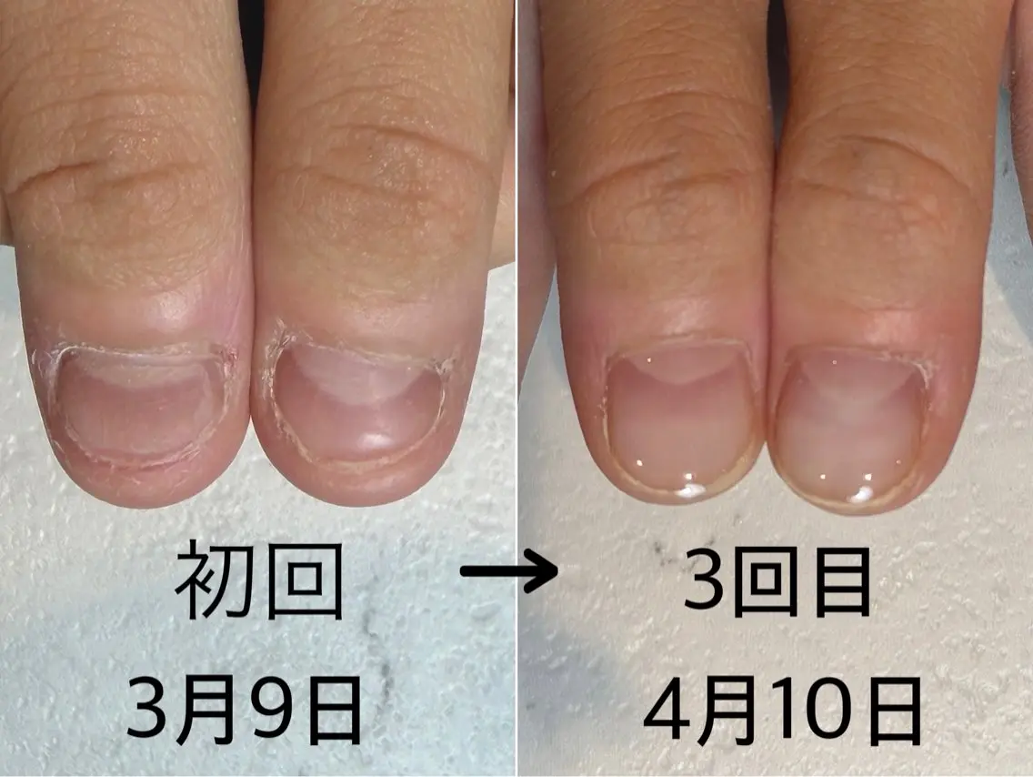 【深爪ケア】（初回ホームケア用品付き）の写真