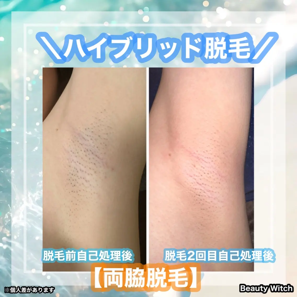 脱毛 痩身/脱毛/ネイル HARUKAのエステ・リラクイメージ