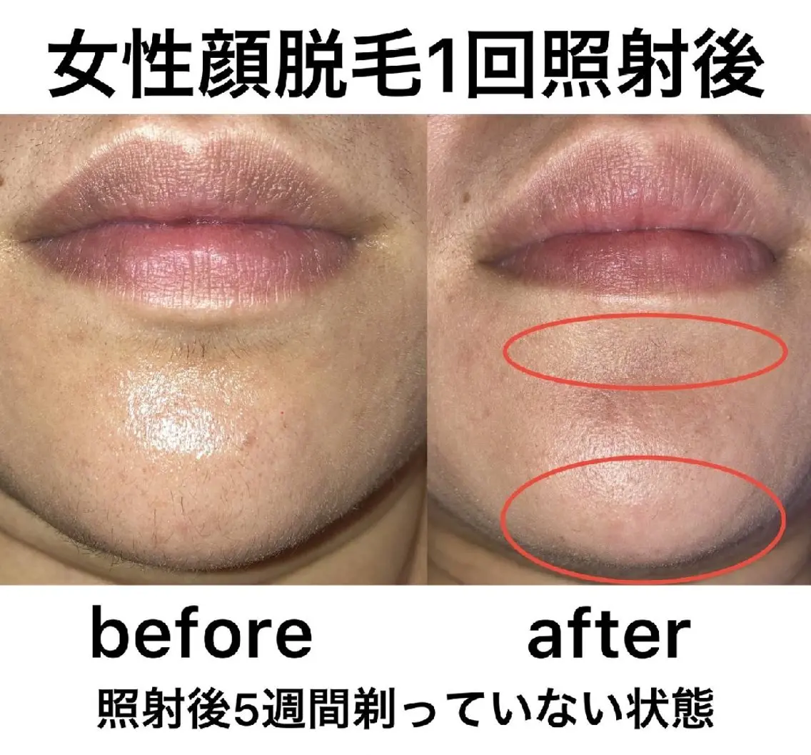 全身脱毛(男性はVIOを除く)の写真