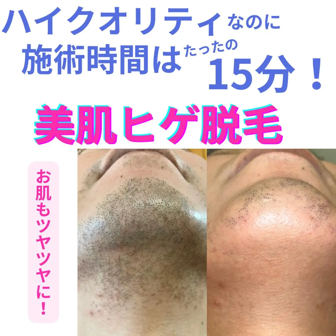 【メンズ】美肌効果あり!美肌ヒゲ脱毛★(美容液たっぷりパックつき)SHR光脱毛の写真