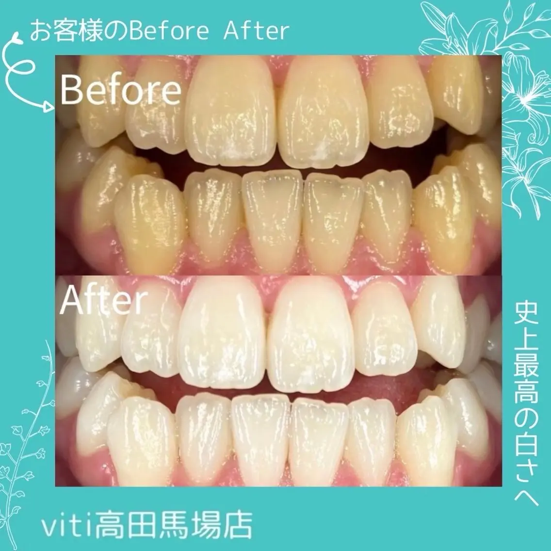💙美容💙セルフホワイトニング30分+カウンセリングの写真