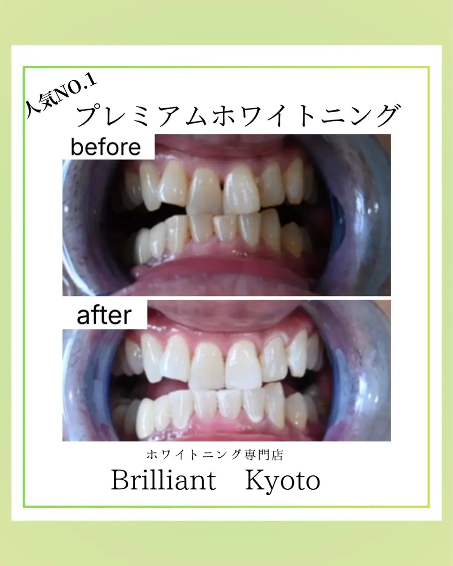プレミアムホワイトニングの写真