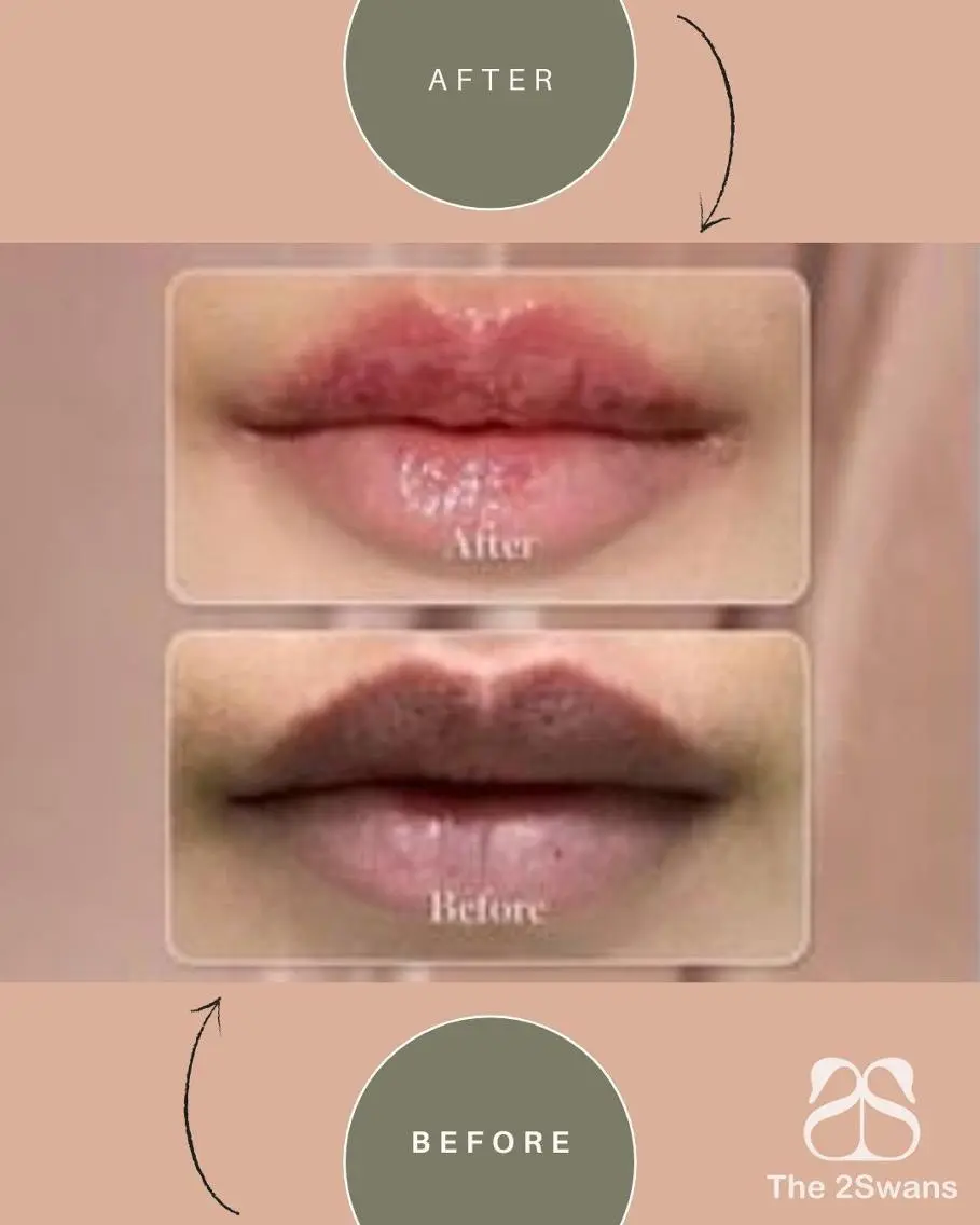 【韓国正規取扱サロン Lemella ルメラ】ピンクに~唇 黒ずみメラニンケアの写真