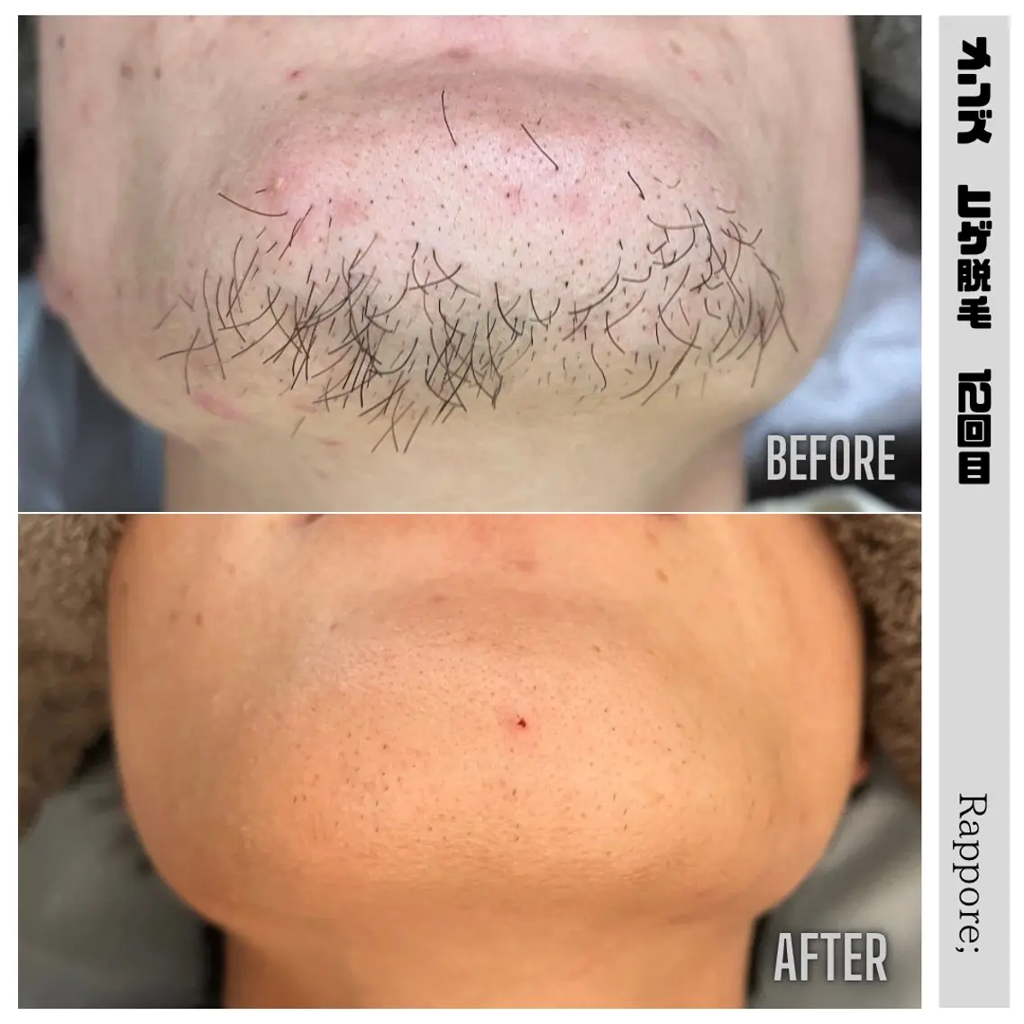 👨メンズヒゲ脱毛👨の写真