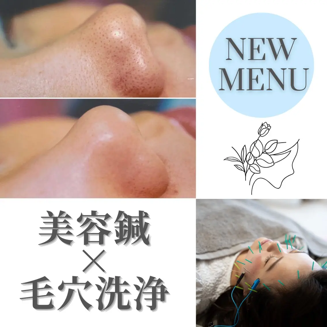 毛穴づまり👃スッキリコース🫧小顔美容鍼＋毛穴洗浄の写真