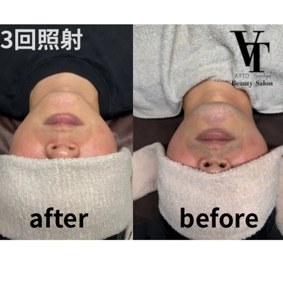 【メンズ初回限定】まずは効果を実感してください！ヒゲ脱毛🧔🧔‍♂️の写真
