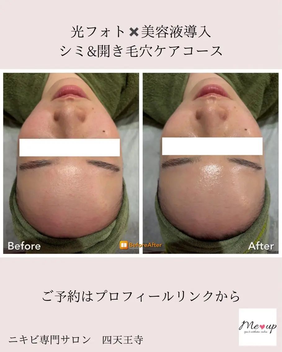 エステ Meup ニキビケア 毛穴・背中ニキビ専門のエステ・リラクイメージ