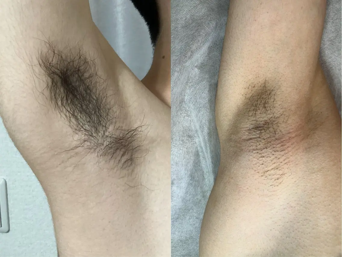 男女 ワキ脱毛の写真