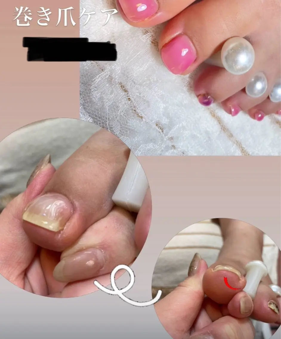 巻き爪矯正＆ワンカラーの写真