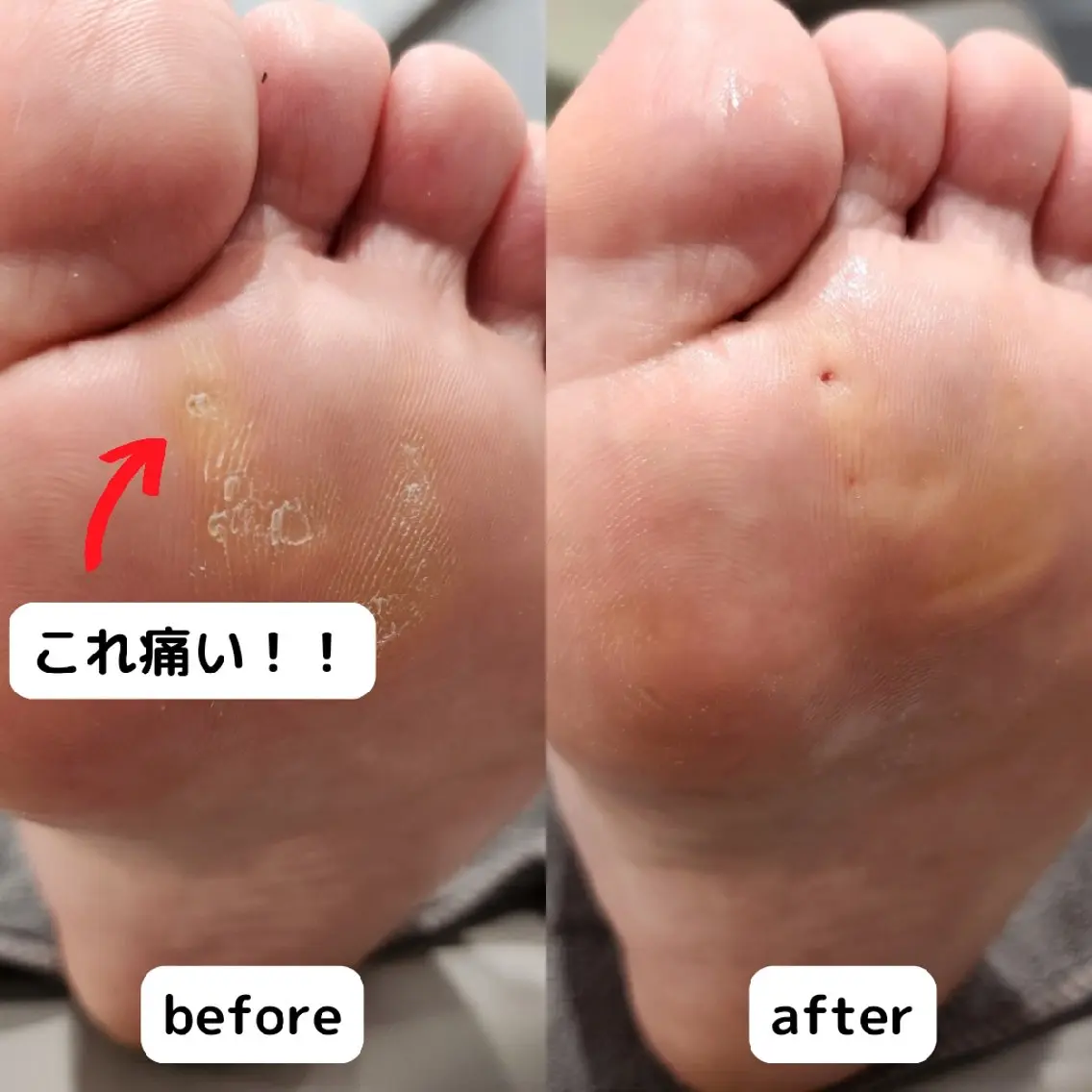 魚の目除去の写真