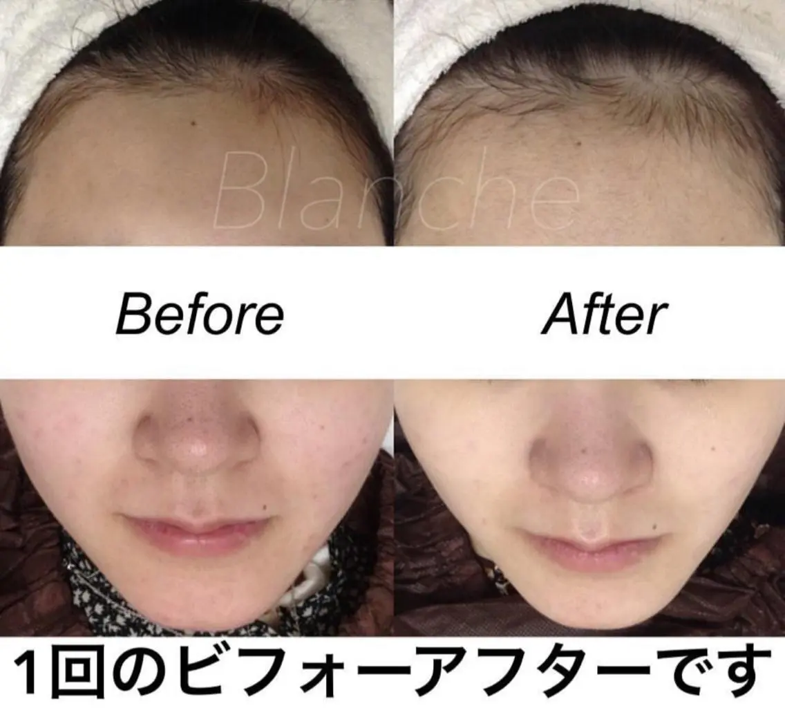 ミディアム カラー パーマ ヘアアレンジ キッズ ネイル マツエク・マツパ エステ リラク 都度払い肌質改善 &脱毛Blancheのエステ・リラクイメージ