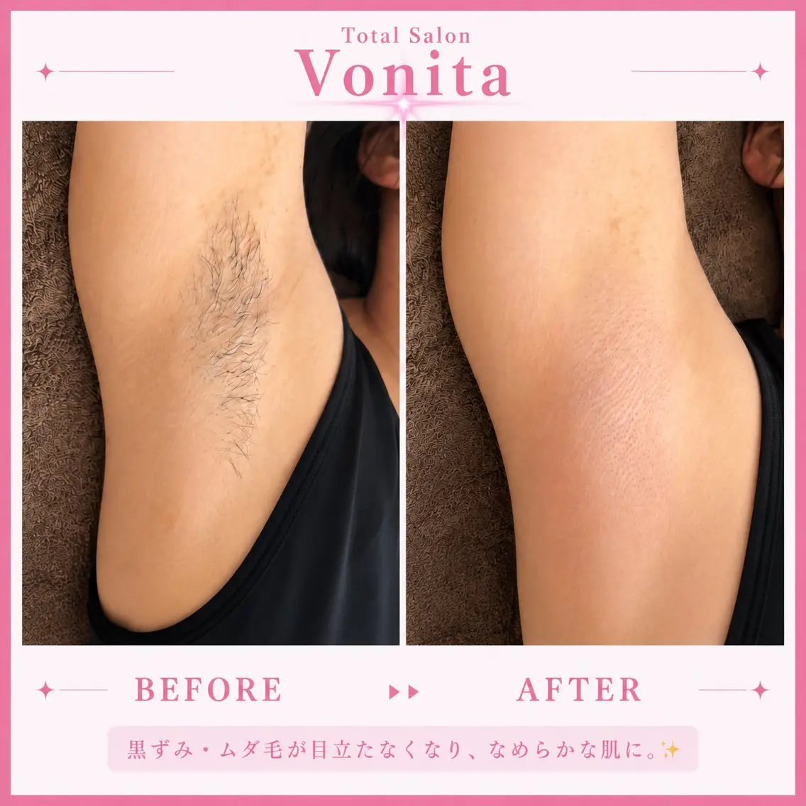 脱毛 Vonita Mikieのエステ・リラクイメージ