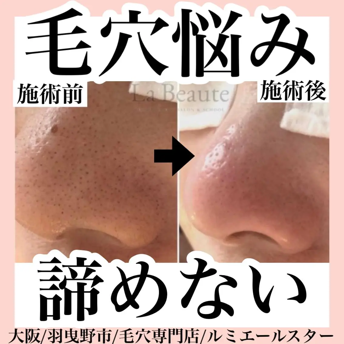 エステ 最速 毛穴シミ改善 いくえのその他イメージ