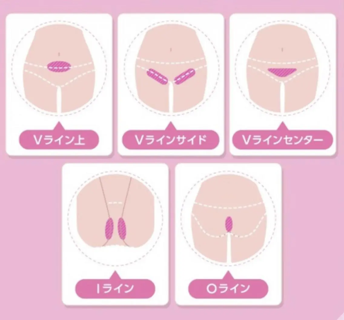 5月限定🌟熱破壊式VIO美肌脱毛🌟完全シェービング付で冷却機能・全当て可能・ホワイトニング効果◎創業40年実績の写真