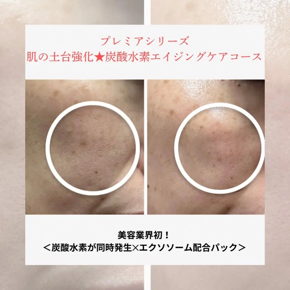 肌の土台強化★炭酸水素エイジングケアメニューの写真