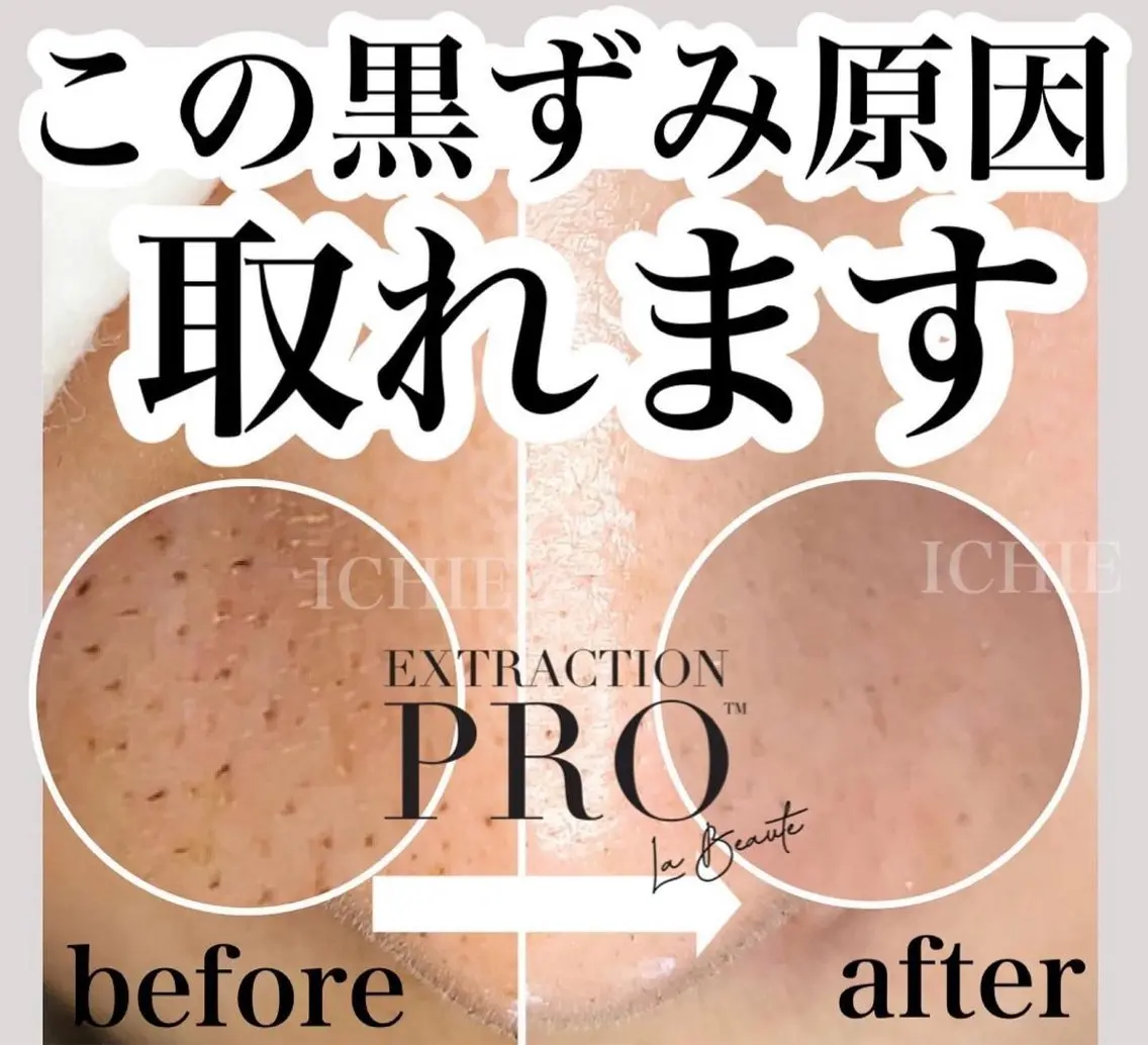 【毛穴美人】毛穴エクストラクションプロ(ヘッドスパorデコルテ付)の写真
