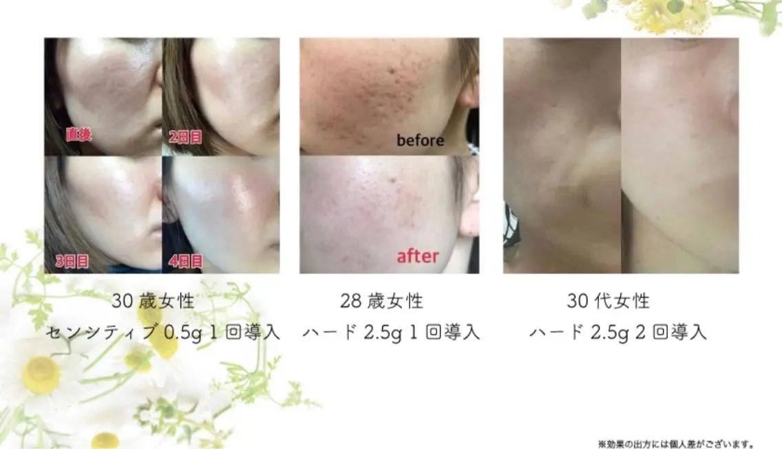 剥離ありハーブピーリング&保湿パック🌿ソフトの写真