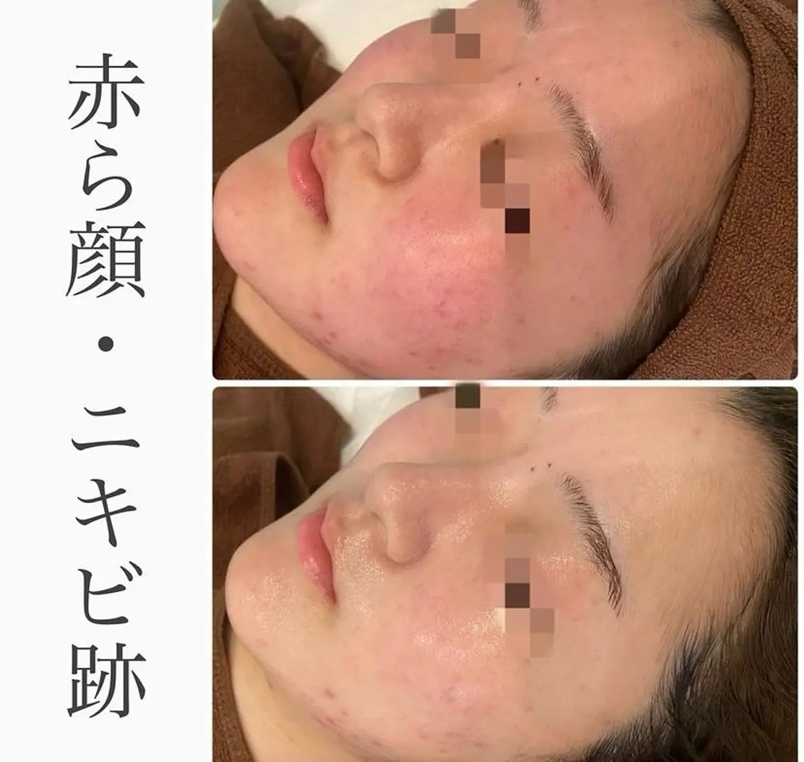 エステ ハーブピーリング専門 BIOPLUS+川崎のエステ・リラクイメージ