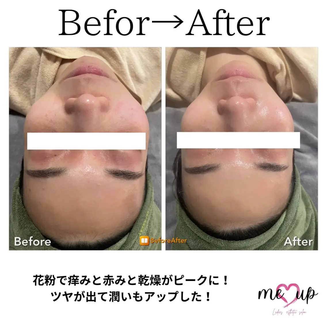 エステ Meupニキビ専門店 背中/ハーブ/肌管理のその他イメージ