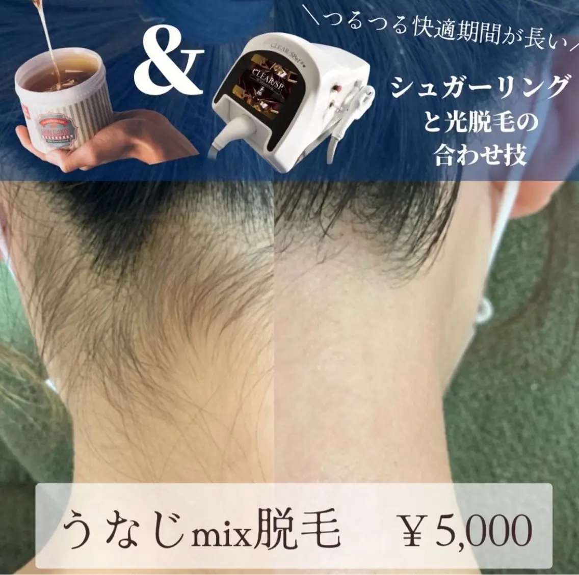 【うなじシュガーリング×最新式光脱毛】の合わせ技！mix脱毛でつるつる長持ち👶 後ろ姿美人✨ 💓デザイン込みの写真