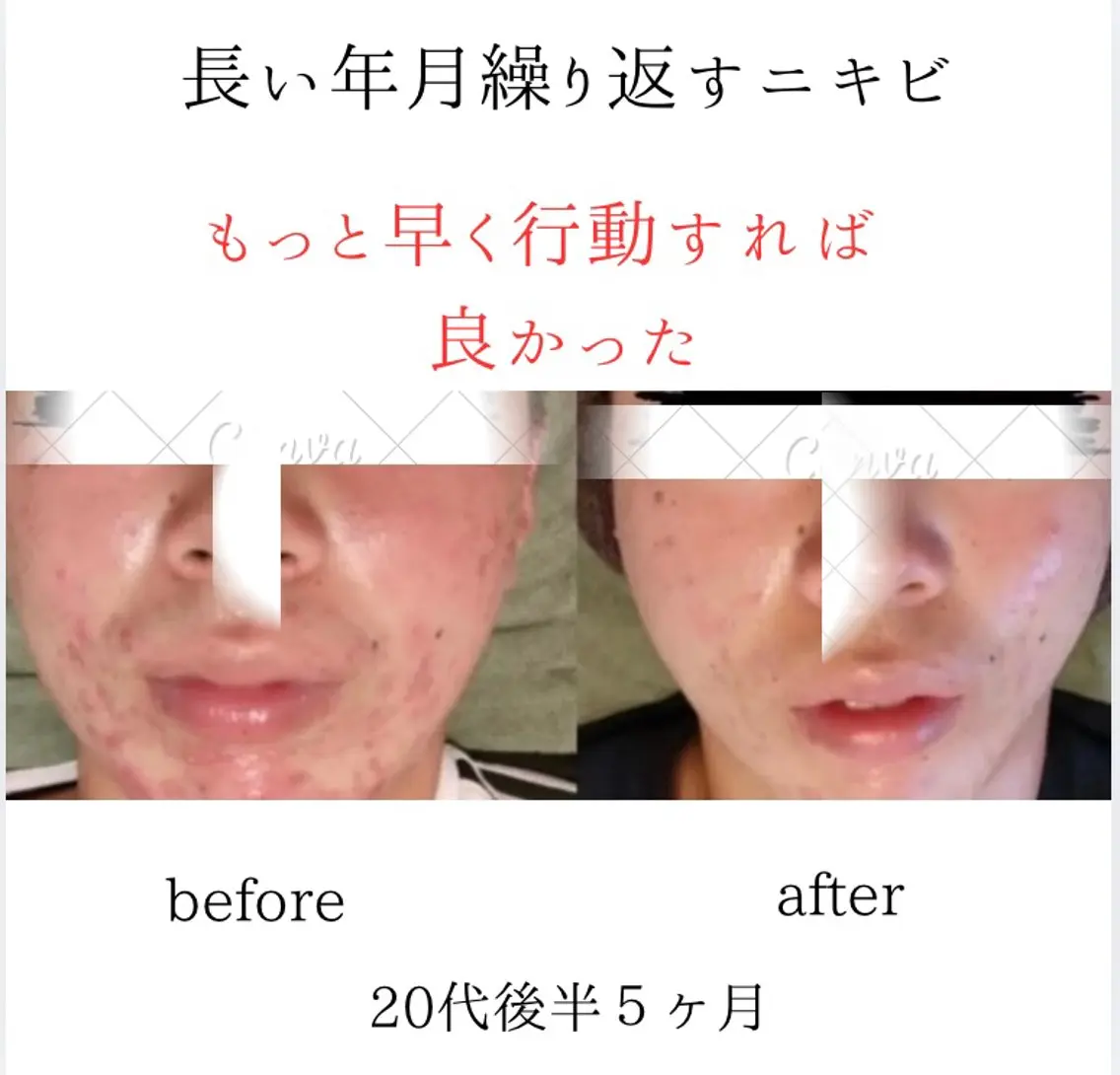 シミニキビ改善 小顔脱毛サロンのエステ・リラクイメージ