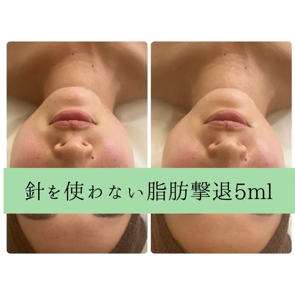 新春☘️モニター☘️針を使わない脂肪撃退🌸後戻り0🙆‍♀️お顔¥19,800⇨¥7000の写真