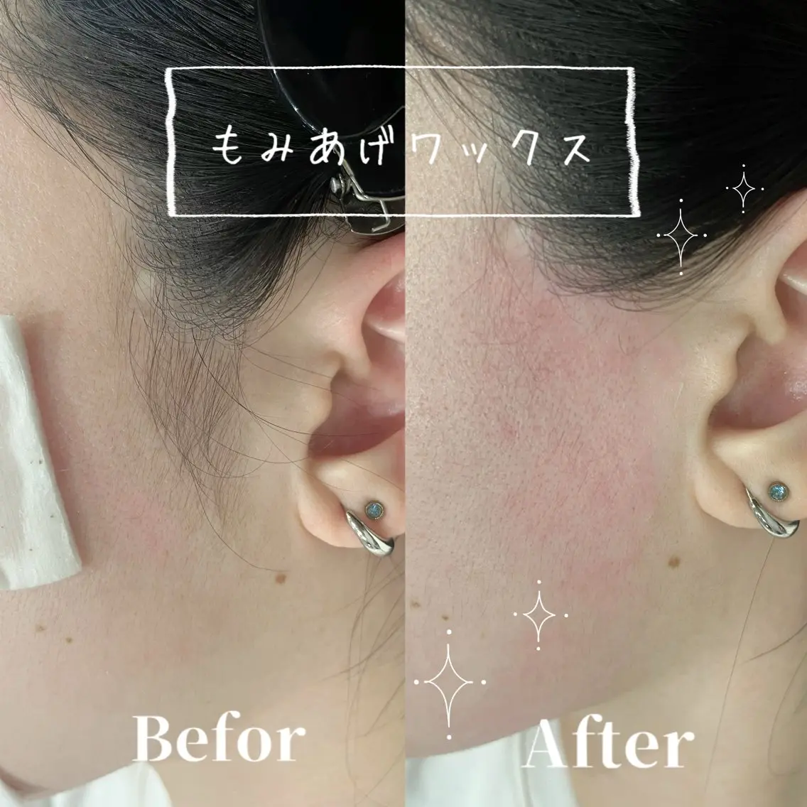🎀女性限定🎀🫧フルフェイシャルワックス🫧(おでこ•頬•小鼻•口周り•もみあげ)ツルツル卵肌へ🥚✨の写真