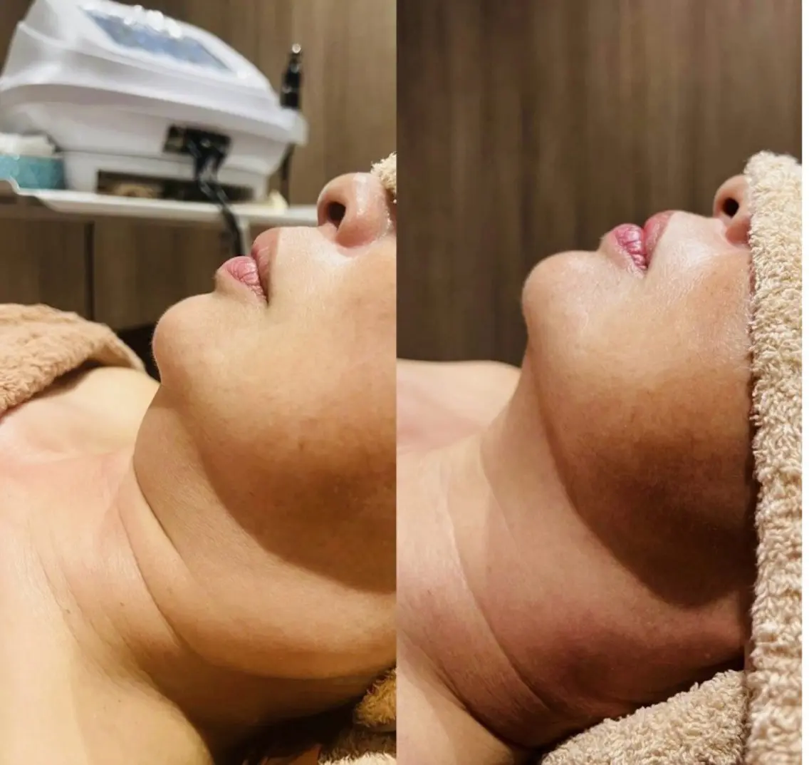 【小顔・たるみケアコース🍋】高周波+脂肪ケア美容液導入(頬+あご下)💆🏻♀️の写真