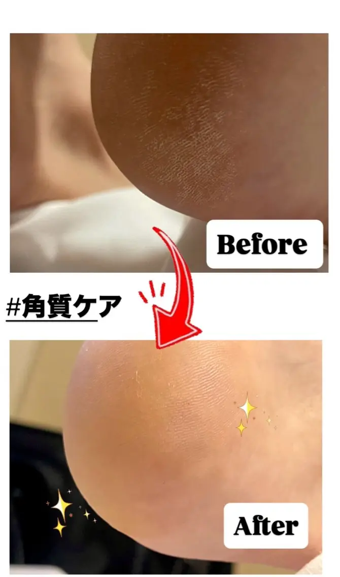 足の角質ケア🦶🏻✨️の写真