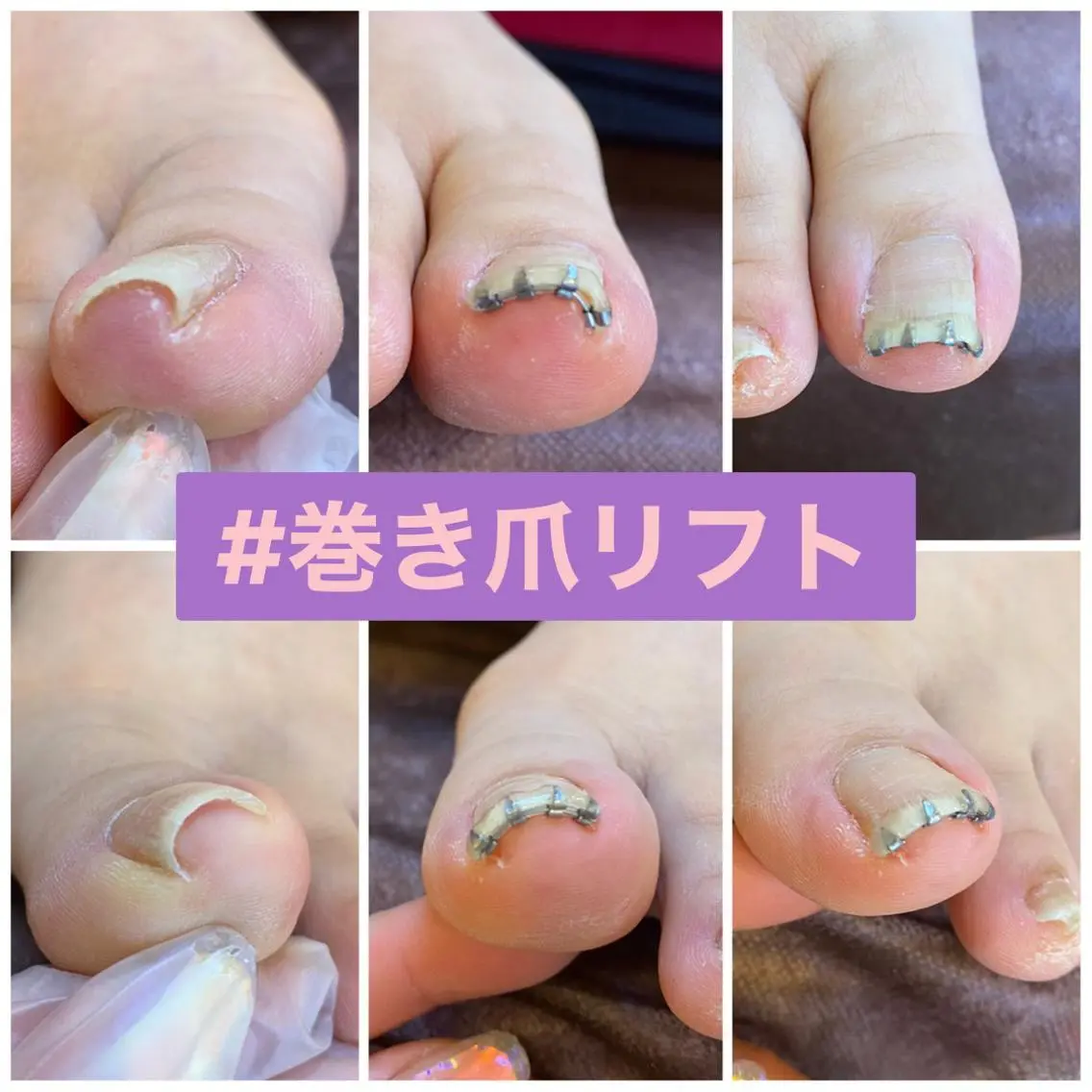 ネイル ♢ME2ROOM♢ #巻き爪#リラクのネイルデザイン
