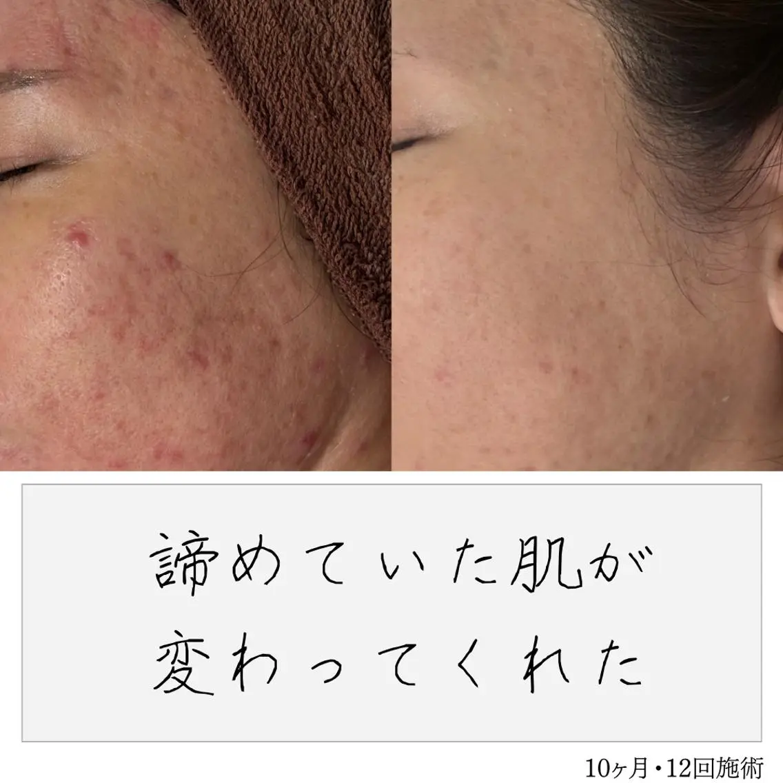 ニキビ経験者が施術 する専門サロン🌻のエステ・リラクイメージ