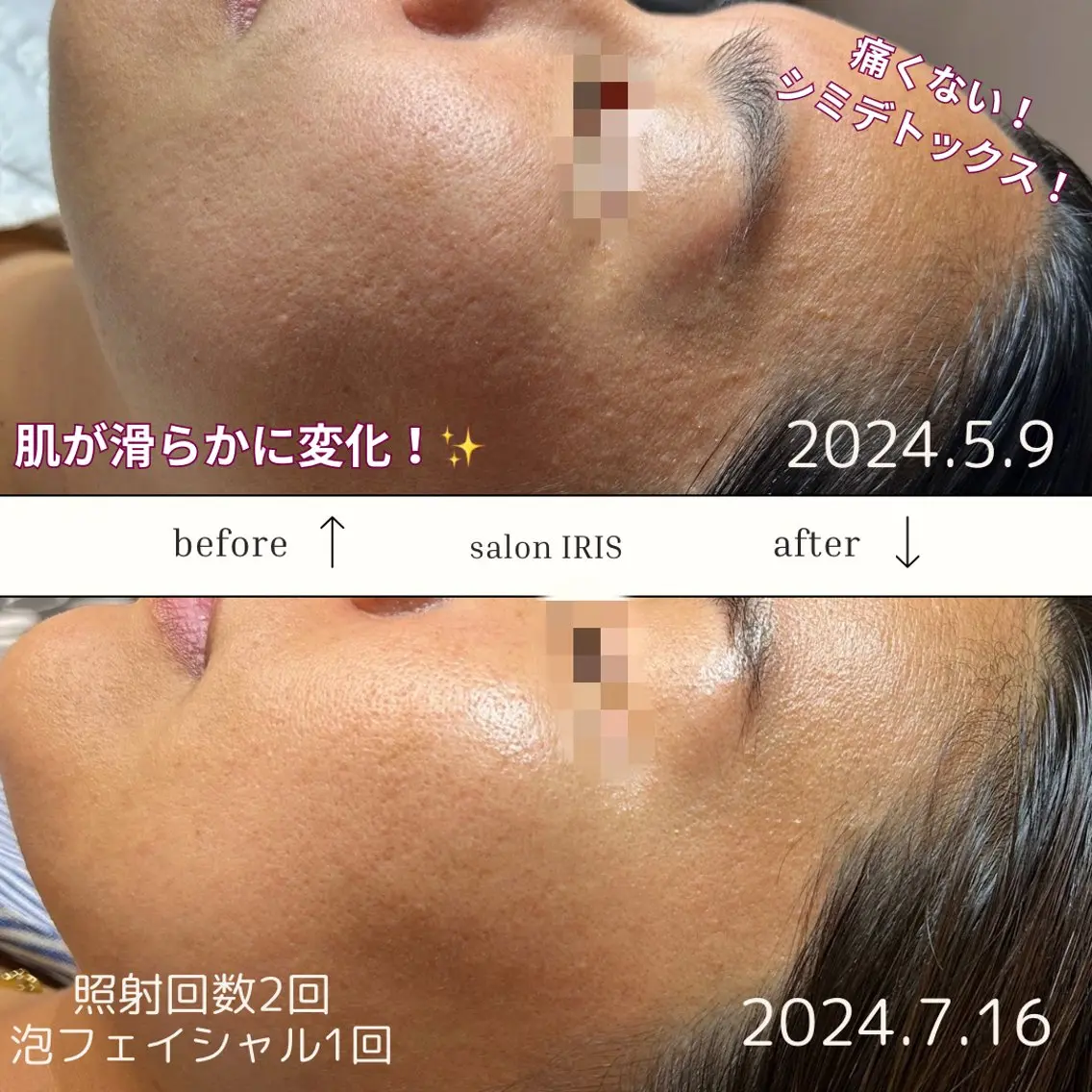 ■シミケア＆泡パックフェイシャル■泡パックし、汚れを除去！軽いピーリング効果も✨その効果によりシミケアの効果を高めます！の写真
